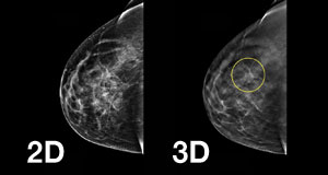 tomosynthesis